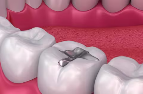 Illustration of molar amalgam filling 3d