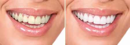Teeth before after whitening pair